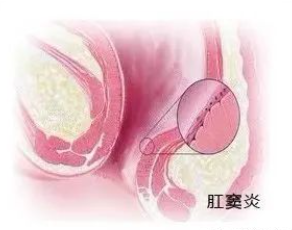 肛竇炎要當(dāng)心，它可讓人不省心！(圖3)